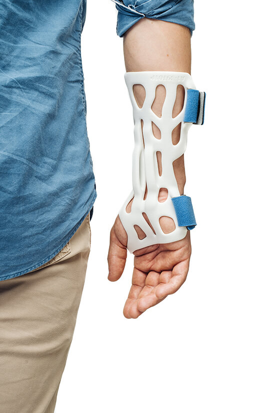 The right hand of a white male wearing a denim shirt with white 3d printed orthotics held together with BASF blue Velcro straps.