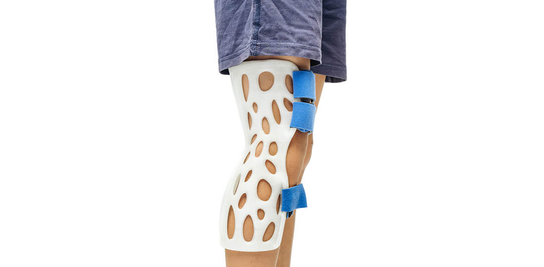A white male's legs in shorts, the right leg wearing white, 3d printed orthoses held together with velcro straps above and below the knee.